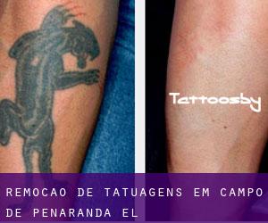 Remoção de tatuagens em Campo de Peñaranda (El)