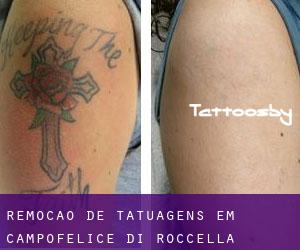 Remoção de tatuagens em Campofelice di Roccella
