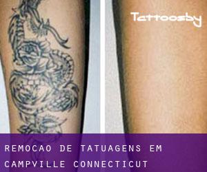 Remoção de tatuagens em Campville (Connecticut)