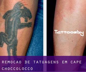 Remoção de tatuagens em Cape Choccolocco