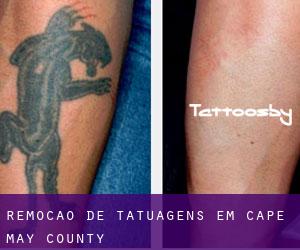 Remoção de tatuagens em Cape May County
