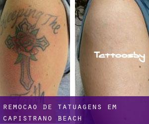 Remoção de tatuagens em Capistrano Beach