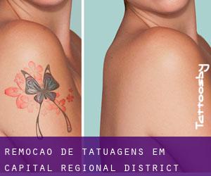 Remoção de tatuagens em Capital Regional District