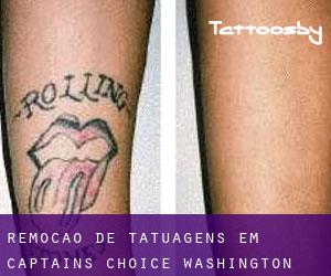 Remoção de tatuagens em Captains Choice (Washington)