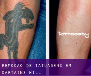 Remoção de tatuagens em Captains Hill