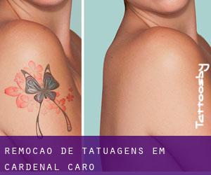 Remoção de tatuagens em Cardenal Caro