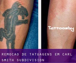 Remoção de tatuagens em Carl Smith Subdivision