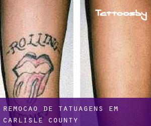 Remoção de tatuagens em Carlisle County