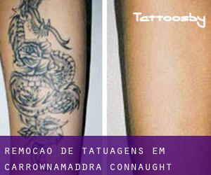 Remoção de tatuagens em Carrownamaddra (Connaught)