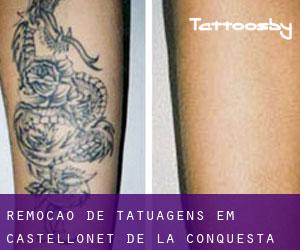 Remoção de tatuagens em Castellonet de la Conquesta