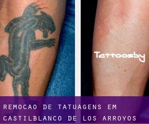 Remoção de tatuagens em Castilblanco de los Arroyos