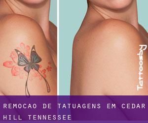 Remoção de tatuagens em Cedar Hill (Tennessee)