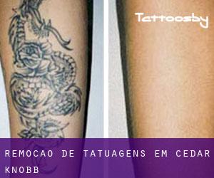 Remoção de tatuagens em Cedar Knobb