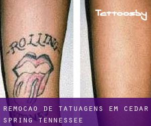 Remoção de tatuagens em Cedar Spring (Tennessee)