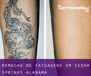 Remoção de tatuagens em Cedar Springs (Alabama)