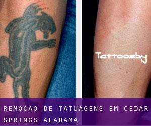 Remoção de tatuagens em Cedar Springs (Alabama)
