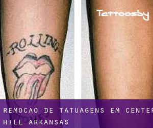 Remoção de tatuagens em Center Hill (Arkansas)