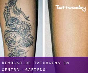 Remoção de tatuagens em Central Gardens