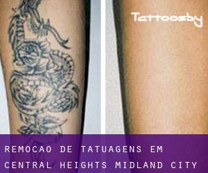 Remoção de tatuagens em Central Heights-Midland City