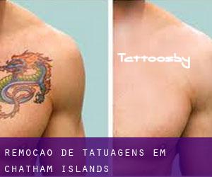 Remoção de tatuagens em Chatham Islands