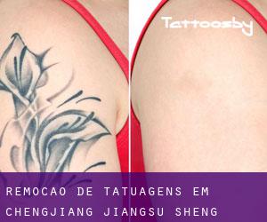 Remoção de tatuagens em Chengjiang (Jiangsu Sheng)