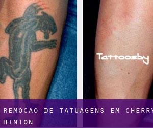 Remoção de tatuagens em Cherry Hinton