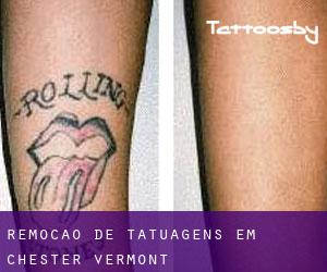 Remoção de tatuagens em Chester (Vermont)