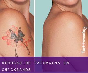 Remoção de tatuagens em Chicksands