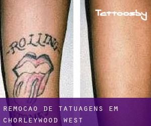 Remoção de tatuagens em Chorleywood West