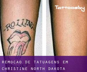 Remoção de tatuagens em Christine (North Dakota)