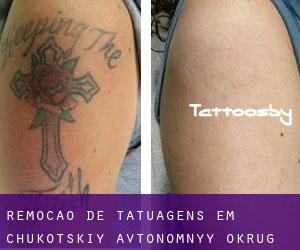 Remoção de tatuagens em Chukotskiy Avtonomnyy Okrug