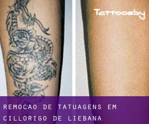 Remoção de tatuagens em Cillorigo de Liébana
