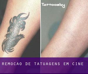 Remoção de tatuagens em Çine