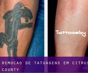 Remoção de tatuagens em Citrus County