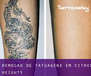 Remoção de tatuagens em Citrus Heights