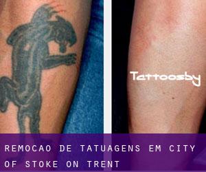 Remoção de tatuagens em City of Stoke-on-Trent