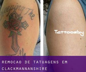 Remoção de tatuagens em Clackmannanshire