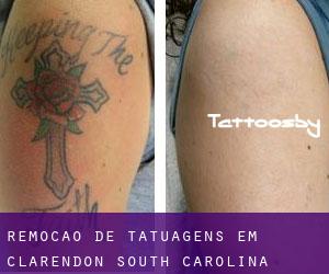 Remoção de tatuagens em Clarendon (South Carolina)
