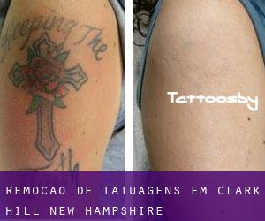 Remoção de tatuagens em Clark Hill (New Hampshire)