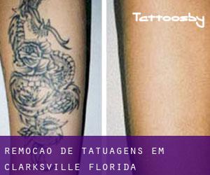 Remoção de tatuagens em Clarksville (Florida)