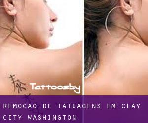 Remoção de tatuagens em Clay City (Washington)