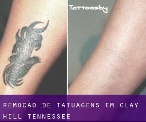 Remoção de tatuagens em Clay Hill (Tennessee)