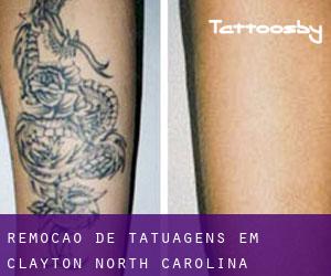 Remoção de tatuagens em Clayton (North Carolina)