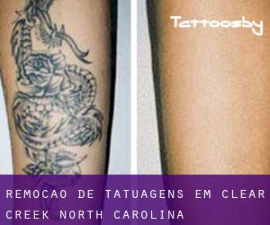 Remoção de tatuagens em Clear Creek (North Carolina)