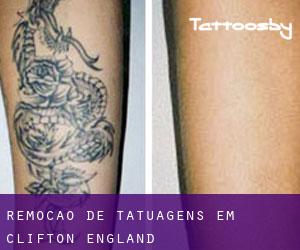 Remoção de tatuagens em Clifton (England)