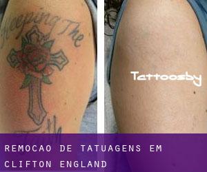 Remoção de tatuagens em Clifton (England)