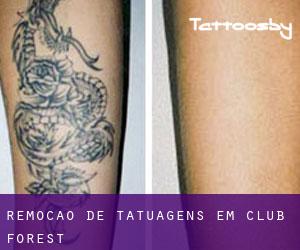 Remoção de tatuagens em Club Forest