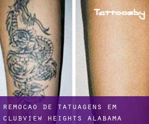 Remoção de tatuagens em Clubview Heights (Alabama)
