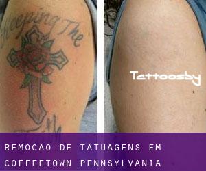 Remoção de tatuagens em Coffeetown (Pennsylvania)