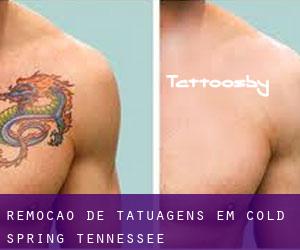 Remoção de tatuagens em Cold Spring (Tennessee)
